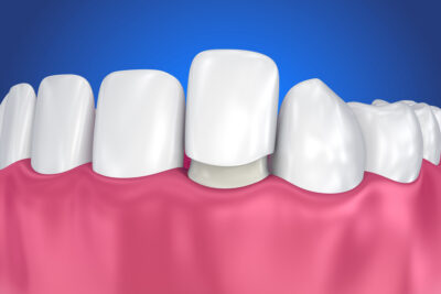 veneer covers tooth and doesn't damage tooth