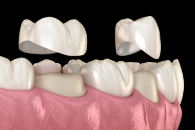 different types of crowns 