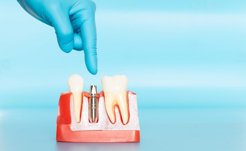 how much do dental implants cost , dental implants in San Jose