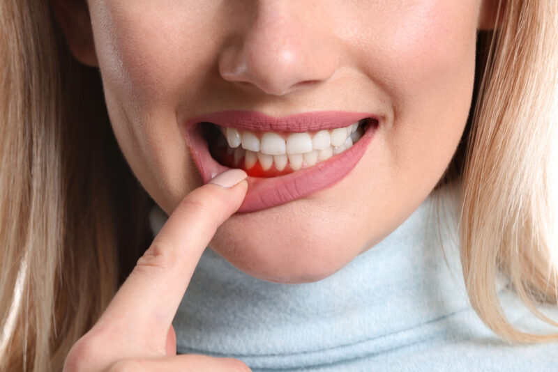 woman showing her bleeding gums, early signs of gingivitis