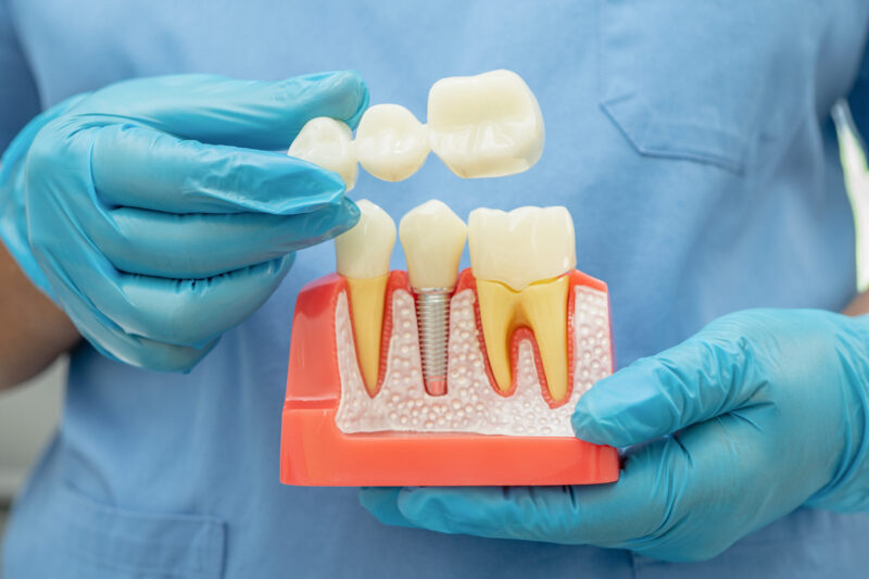 tooth implant vs dental bridge, dentist showing patient the two options