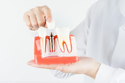 dentist showing model with dental implants 