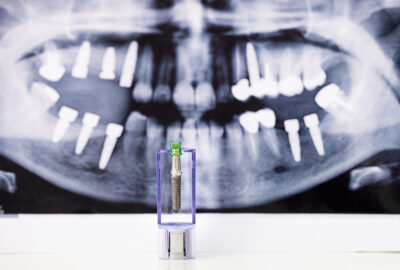 x-ray showing dental implants 