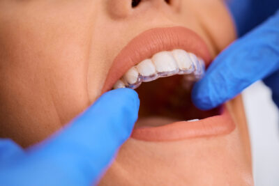 close up picture of woman's mouth and she has Invisalign 