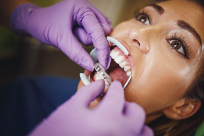 woman getting Invisalign aligners 