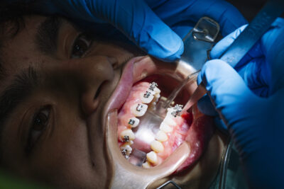 young kid at dentist getting braces 