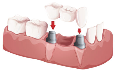 dental bridge - illustration of what it looks like to replace one tooth 