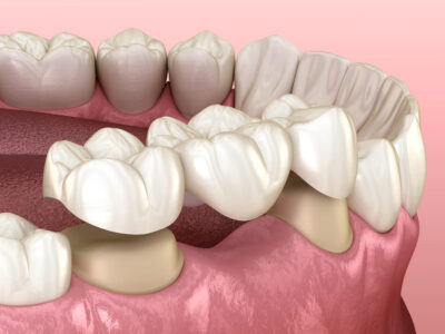 dental bridge procedure 