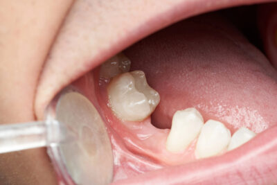 patient missing tooth is ideal for all on x dental implants 