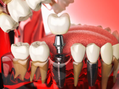 model of human teeth using all on x dental implants 