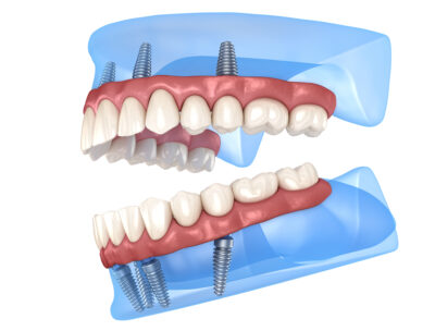 all on 4 dental implants image of teeth and implants 