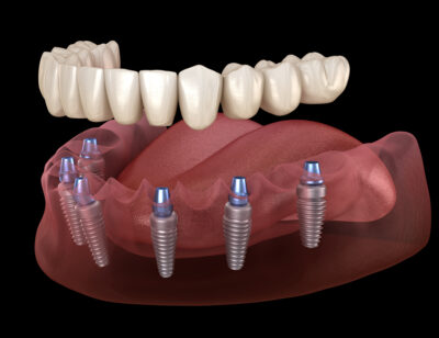 full arch dental implant for missing teeth 