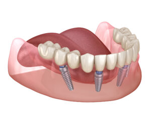 graphic image of dental implant posts in jaw 