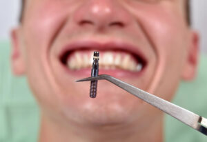 tweezers holding screw that is used for full arch dental implants