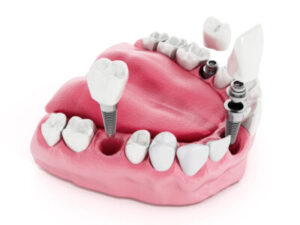 model of dental implants with screws 