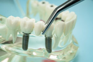 dental implant model - what a dental implant looks like 