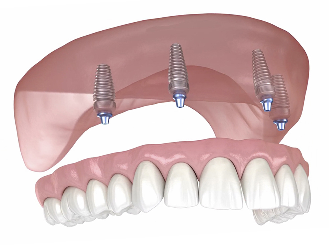 All-on-4 Dental Implants