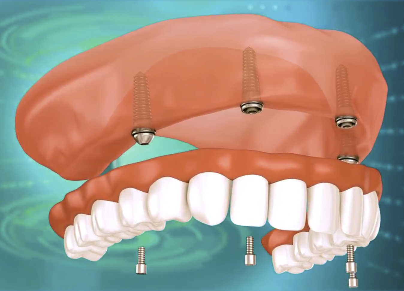 All-on-4 Dental Implants